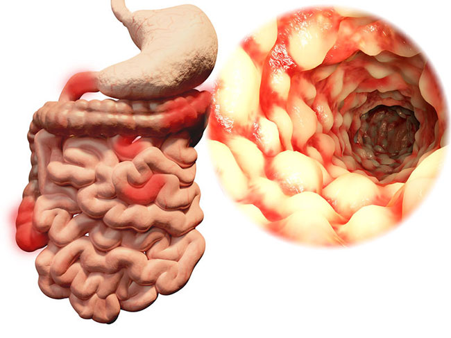 What is Crohn's Disease?